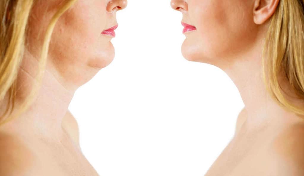 Double Chin treatment Enfield Island Village before and after results