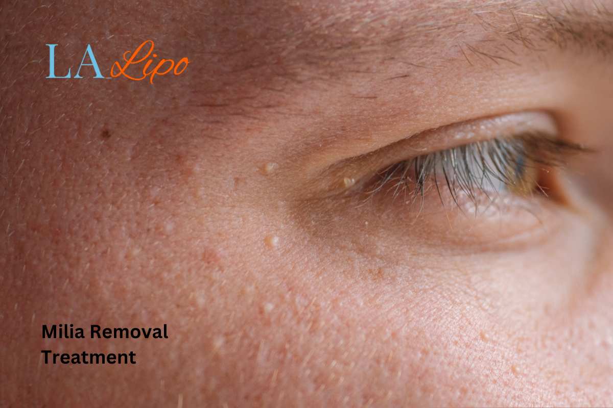 Cryopen Milia Removal: Is It the Easiest and Safest Option Enfield Island Village?