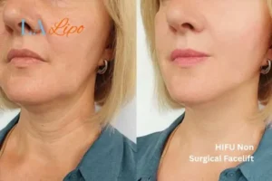hi-fu for wrinkles Enfield Island Village before and after results