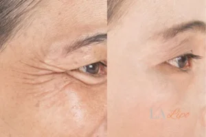 Before and after results of woman - HI-fu wrinkles reduction treatment Enfield Island Village