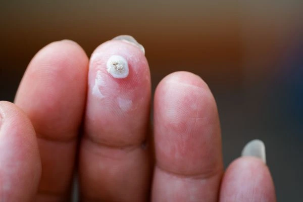 wart on person finger - cryotherapy to treat from LA LIPO Enfield Island Village