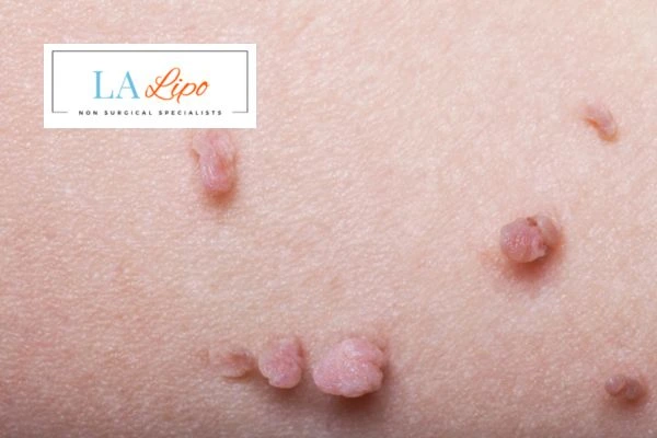 Does cryopen skin tag removal Enfield Island Village hurt? Find out now call our team today!