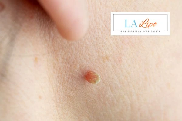Book skin tag removal Enfield Island Village today speak to our team now!