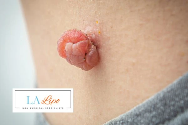 Interested in skin tag removal Enfield Island Village? Concerned about the pain? Find out more today!