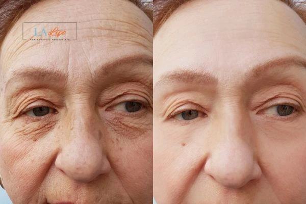 The powerful benefits of Morpheus8 Treatment Enfield Island Village - Call Our team today!